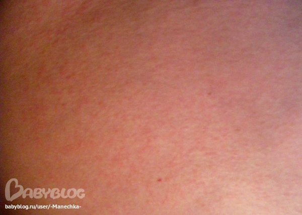 Красная сыпь на животе груди руках - запись пользователя Машуля ...