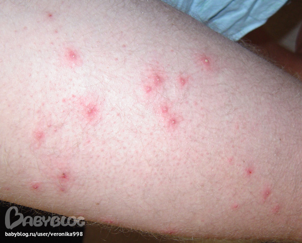 фурункулез? - запись пользователя Nikyhka (nikyhka) в сообществе ...