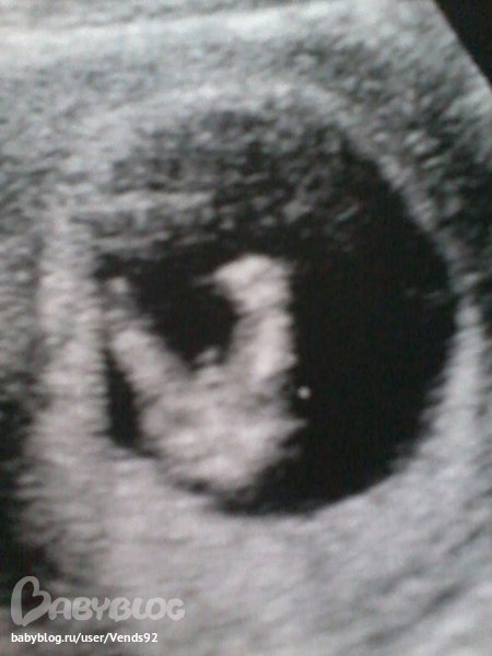 Мальчик на узи 12 недель. УЗИ 12 недель беременности мальчик. УЗИ плод девочка 12 недель беременности. УЗИ 14 недель беременности пол мальчик. УЗИ 12 недель беременности пол мальчик.
