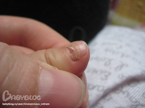 Онихомадезис – отслойка ногтя у основания