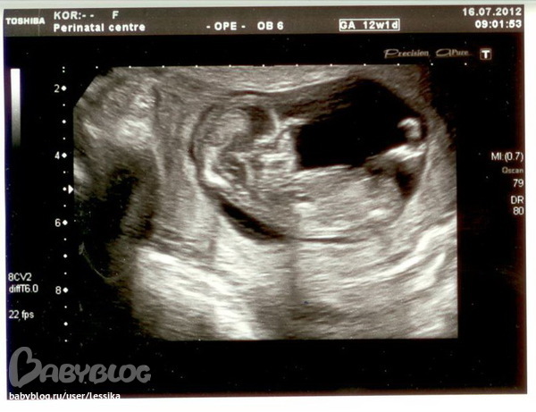 14 недель мальчик. УЗИ 13 недель беременности. Снимок УЗИ 13 недель беременности мальчик. УЗИ 13-14 недель беременности. УЗИ 13-14 недель беременности мальчик.