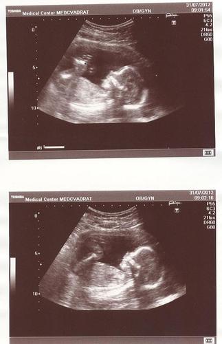 Эмбрион 18 Недель Фото
