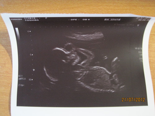 Фото узи на 22 неделе беременности фото