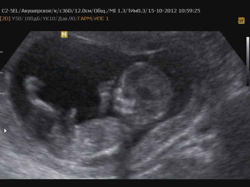 Беременность 12 недель мальчик. Снимок УЗИ на 12 неделе мальчик. УЗИ ребенка на 12 неделе беременности фото мальчик. Снимок УЗИ на 12 неделе. УЗИ 11 недель мальчик.