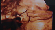 Фото УЗИ на 32 неделе беременности