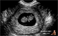 Фото УЗИ на 1 неделе беременности