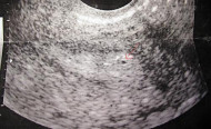 Фото УЗИ на 2 неделе беременности